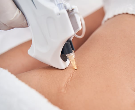 Medical Tattooing vs. PMU: Key Differences