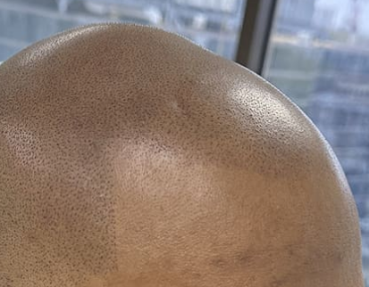Follicule SMP: The Future of Hairline Enhancement